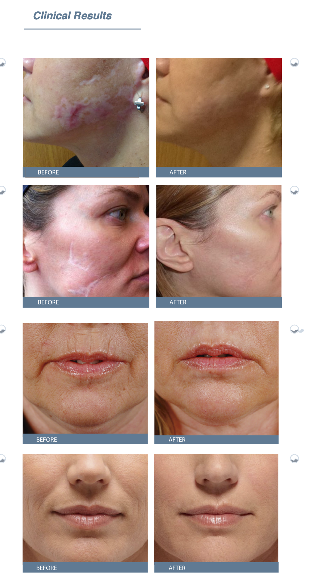 Dermica Double HA repair before after